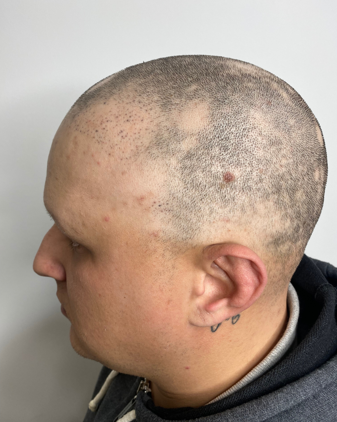 Antes — Alopecia Areata